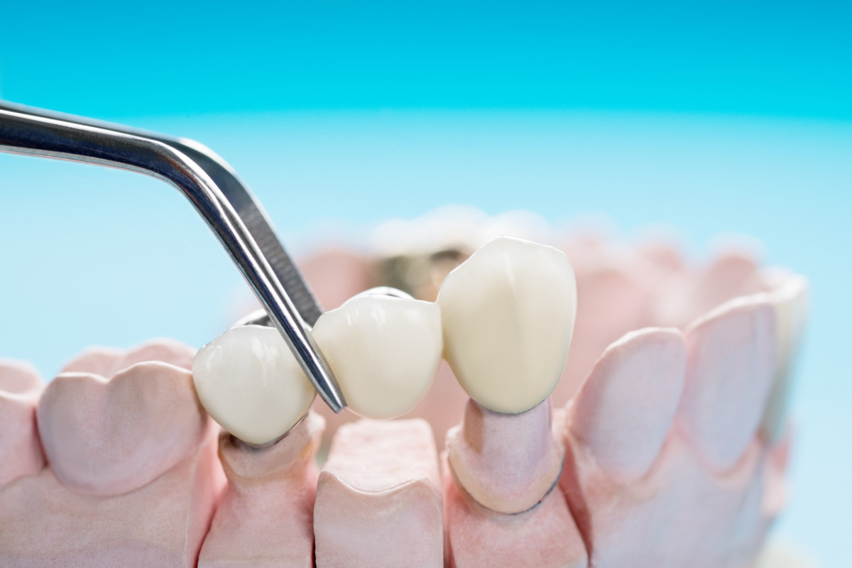 concept of dental bridges improve your smile