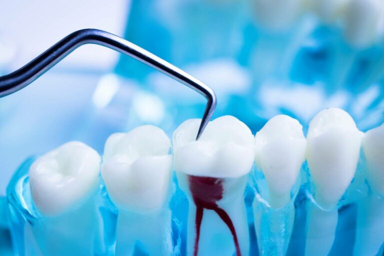 How Long Does a Root Canal Take to Heal? Baseline Dental Care