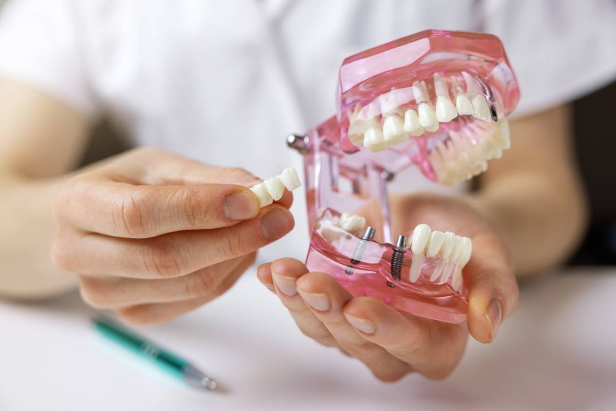 featured image for implants versus dentures