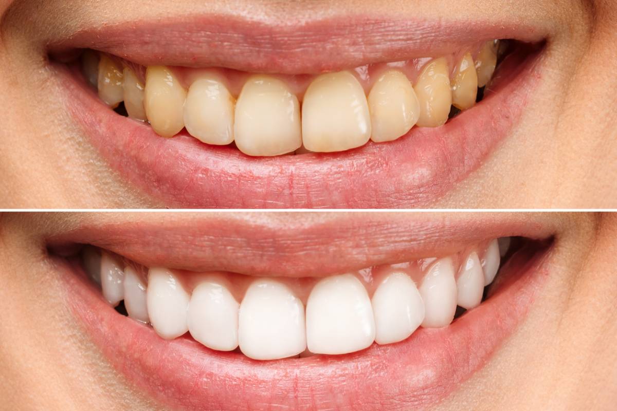 concept of teeth after teeth whitening from dentist