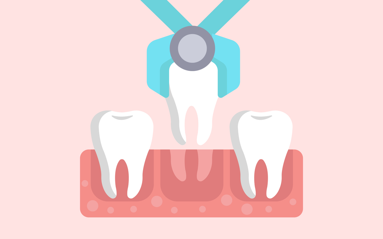 The image is an illustration of a tooth extraction to represent the signs it is time to have your tooth extracted.