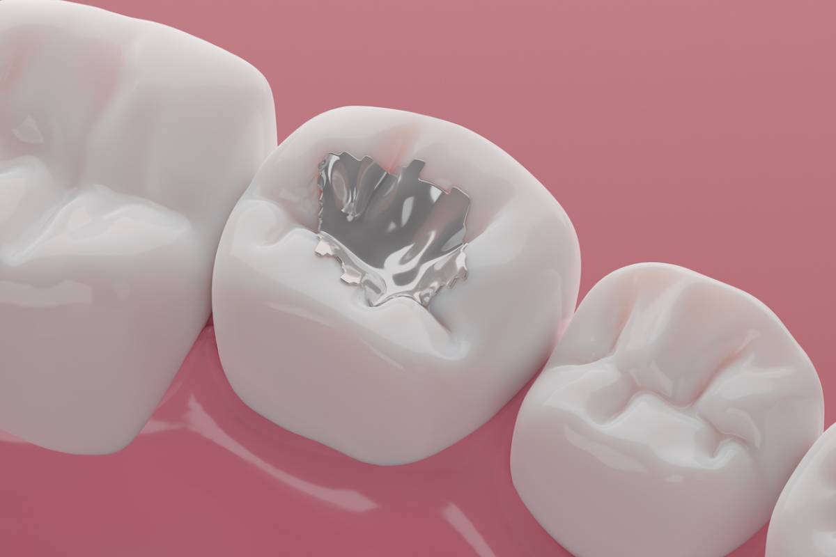 Featured image for Are Dental Fillings Painful