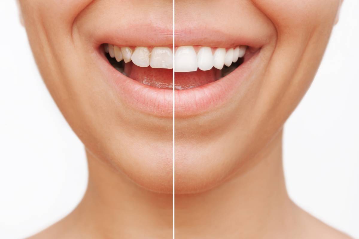 Featured image for How Long Do Veneers Last?